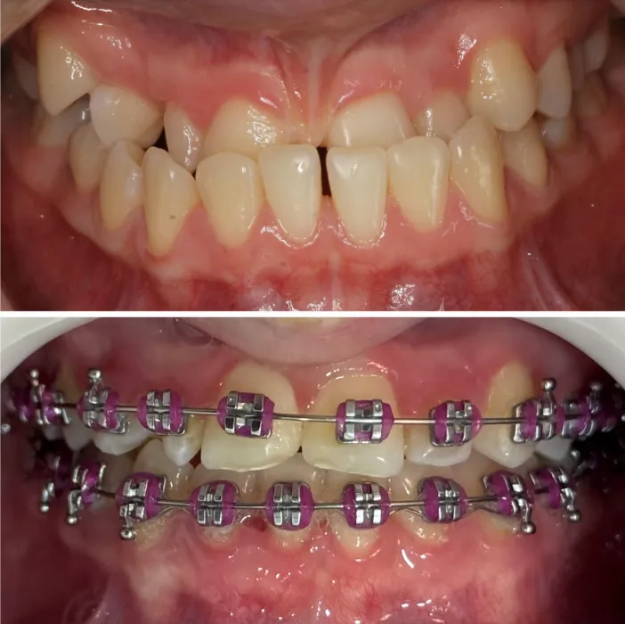 Dentes desalinhados antes do tratamento, em cima, e já com aparelho ortodôntico, embaixo