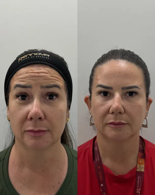 Rosto de frente de uma paciente antes e depois do botox, com menos linhas na testa
