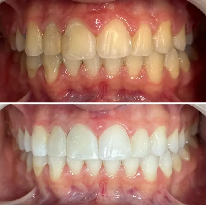 Dentes amarelados antes do clareamento, em cima, e mais brancos depois, embaixo