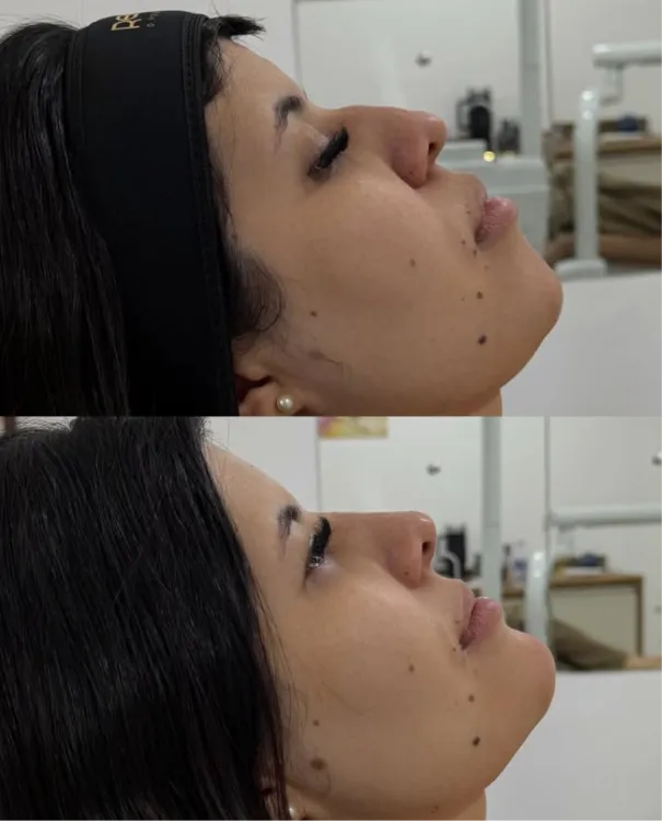Perfil de uma paciente antes, em cima, e depois da harmonização facial, embaixo, mostrando lábios e queixo