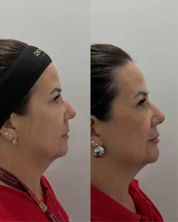 Perfil de uma paciente antes e depois da perfiloplastia, mostrando o contorno do queixo e da mandíbula