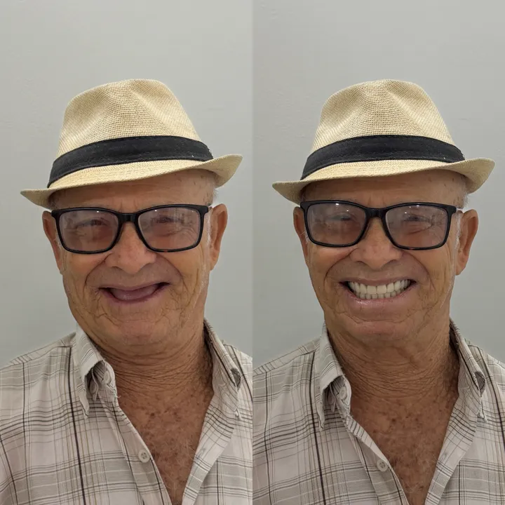 Paciente de chapéu e óculos sorrindo antes, à esquerda, e depois da prótese dentária, à direita, com os dentes da frente repostos