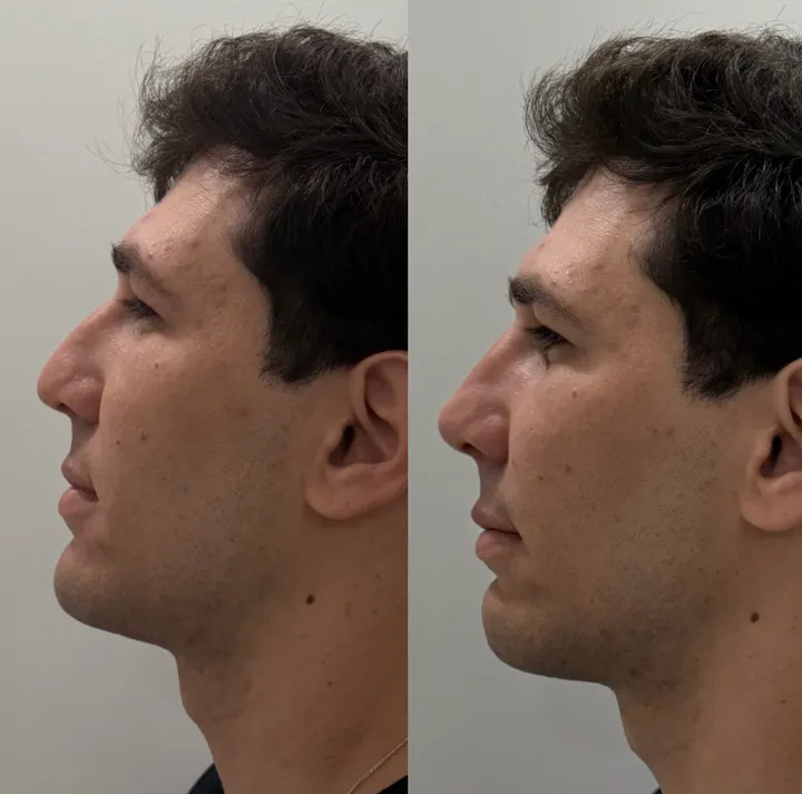 Perfil de um paciente antes e depois da rinomodelação, com o dorso do nariz mais reto
